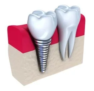 A graphic recreation of a dental implant in the jawbone.