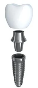A graphic image of a dental implant.